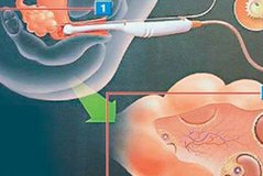 在濮阳市做试管婴儿长方案周期需要多久？超长方案促排流程是怎么样的？